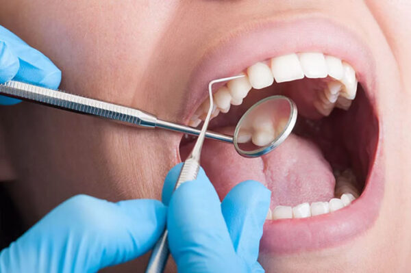 Periodoncia – Detartraje con Ultrasonido